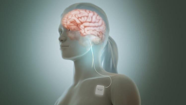 Vagus Nerve Stimulation