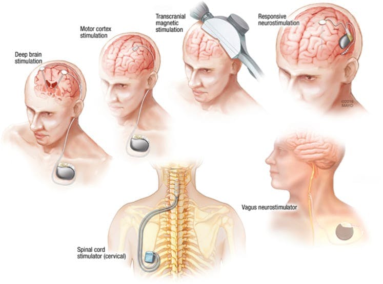 different types of Neurostimulation - a detailed explanation 